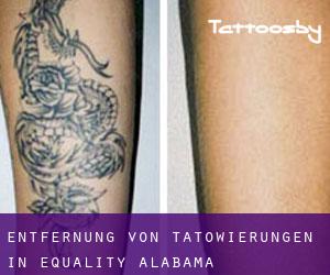 Entfernung von Tätowierungen in Equality (Alabama)