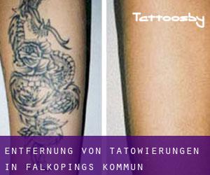 Entfernung von Tätowierungen in Falköpings Kommun
