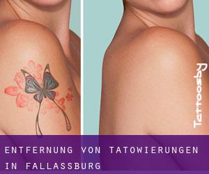 Entfernung von Tätowierungen in Fallassburg