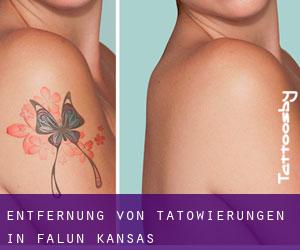 Entfernung von Tätowierungen in Falun (Kansas)