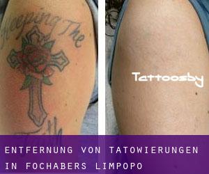 Entfernung von Tätowierungen in Fochabers (Limpopo)