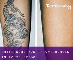 Entfernung von Tätowierungen in Fords Bridge