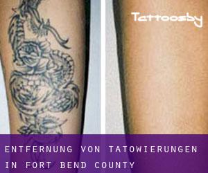 Entfernung von Tätowierungen in Fort Bend County