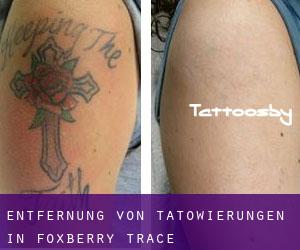 Entfernung von Tätowierungen in Foxberry Trace