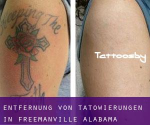 Entfernung von Tätowierungen in Freemanville (Alabama)