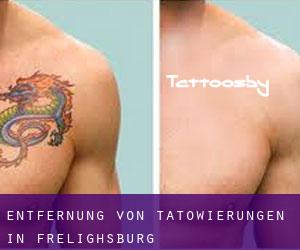 Entfernung von Tätowierungen in Frelighsburg