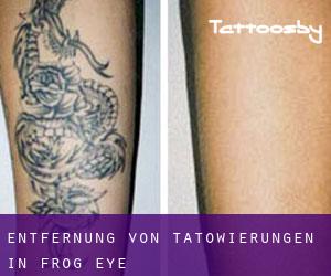 Entfernung von Tätowierungen in Frog Eye