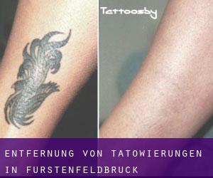 Entfernung von Tätowierungen in Fürstenfeldbruck
