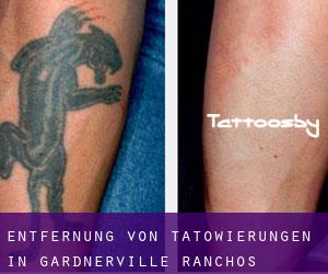 Entfernung von Tätowierungen in Gardnerville Ranchos