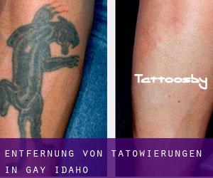 Entfernung von Tätowierungen in Gay (Idaho)