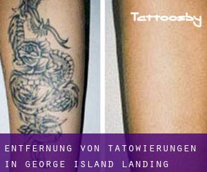 Entfernung von Tätowierungen in George Island Landing