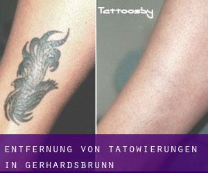 Entfernung von Tätowierungen in Gerhardsbrunn