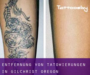Entfernung von Tätowierungen in Gilchrist (Oregon)