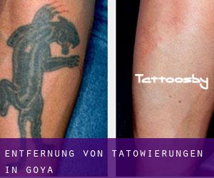 Entfernung von Tätowierungen in Goya