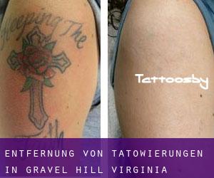 Entfernung von Tätowierungen in Gravel Hill (Virginia)