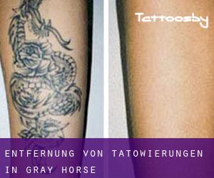 Entfernung von Tätowierungen in Gray Horse