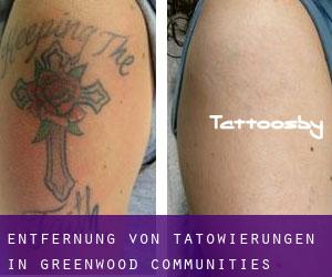 Entfernung von Tätowierungen in Greenwood Communities