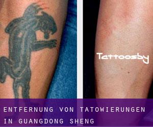 Entfernung von Tätowierungen in Guangdong Sheng