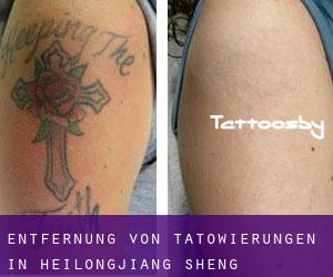 Entfernung von Tätowierungen in Heilongjiang Sheng