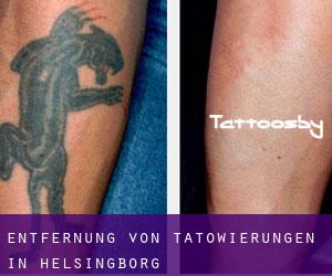 Entfernung von Tätowierungen in Helsingborg