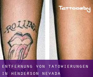 Entfernung von Tätowierungen in Henderson (Nevada)