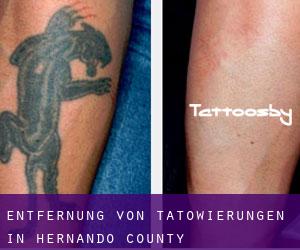 Entfernung von Tätowierungen in Hernando County