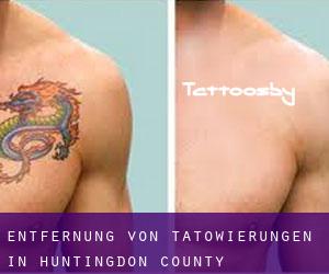 Entfernung von Tätowierungen in Huntingdon County