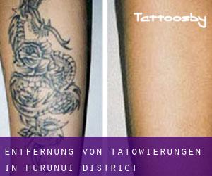 Entfernung von Tätowierungen in Hurunui District