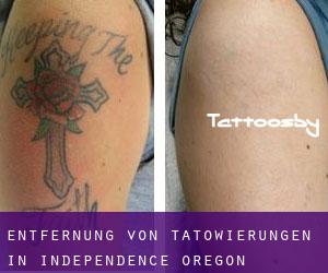 Entfernung von Tätowierungen in Independence (Oregon)