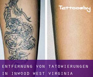 Entfernung von Tätowierungen in Inwood (West Virginia)