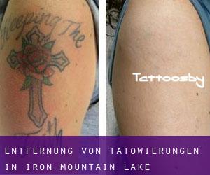 Entfernung von Tätowierungen in Iron Mountain Lake