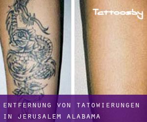 Entfernung von Tätowierungen in Jerusalem (Alabama)