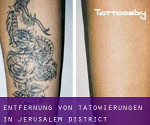 Entfernung von Tätowierungen in Jerusalem District
