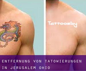 Entfernung von Tätowierungen in Jerusalem (Ohio)