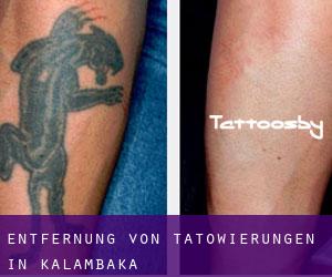 Entfernung von Tätowierungen in Kalambaka