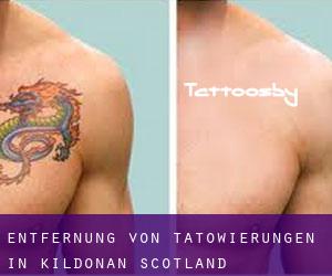 Entfernung von Tätowierungen in Kildonan (Scotland)