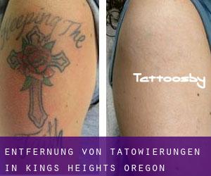 Entfernung von Tätowierungen in Kings Heights (Oregon)