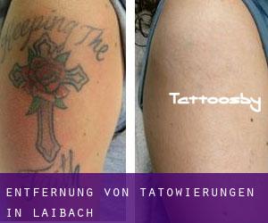 Entfernung von Tätowierungen in Laibach