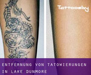 Entfernung von Tätowierungen in Lake Dunmore
