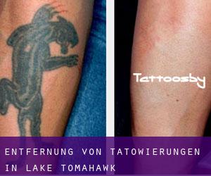 Entfernung von Tätowierungen in Lake Tomahawk