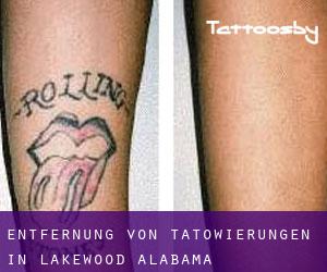 Entfernung von Tätowierungen in Lakewood (Alabama)
