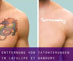 Entfernung von Tätowierungen in Latulipe-et-Gaboury