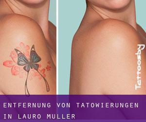 Entfernung von Tätowierungen in Lauro Muller