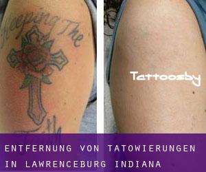Entfernung von Tätowierungen in Lawrenceburg (Indiana)