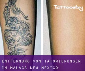 Entfernung von Tätowierungen in Malaga (New Mexico)