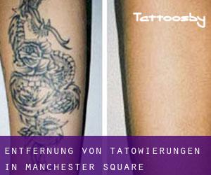 Entfernung von Tätowierungen in Manchester Square