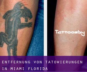 Entfernung von Tätowierungen in Miami (Florida)