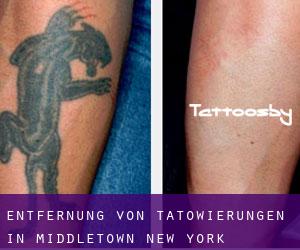 Entfernung von Tätowierungen in Middletown (New York)