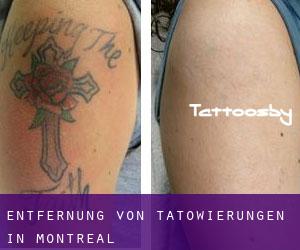 Entfernung von Tätowierungen in Montreal