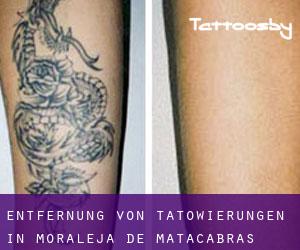 Entfernung von Tätowierungen in Moraleja de Matacabras